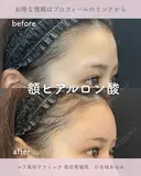 額ヒアルロン酸 before画像 サムネイル用
