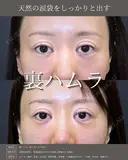 【クマ治療】裏ハムラ法 before画像 サムネイル用