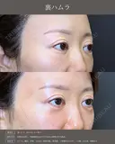 【クマ治療】裏ハムラ法 after画像 サムネイル用