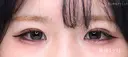 【10代女性・埋没法でナチュラル二重に】 二重術（埋没法）：マイクロメソッド+α（1ヶ月後） 30日後 サムネイル用