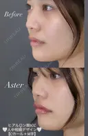 【リップ】ヒアルロン酸注入 after画像 サムネイル用