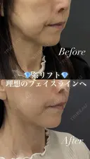 銀美式糸リフト before画像 サムネイル用