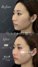 【涙袋】【LIP】【貴族】ヒアルロン酸注入 after画像 サムネイル用