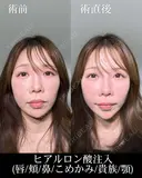 ヒアルロン酸注入（唇/頬/鼻/こめかみ/貴族/顎） after画像 サムネイル用