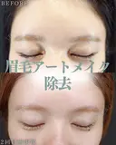 眉毛アートメイク除去 before画像 サムネイル用