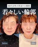 岩﨑先生による🔥小顔整形🔥 before画像 サムネイル用