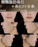 サクションリフト 90日後 サムネイル用