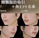 サクションリフト 90日後 サムネイル用