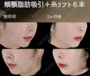 サクションリフト 30日後 サムネイル用