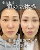 人中短縮　貴族プロテーゼ　逆さまつ毛修正 before画像 サムネイル用