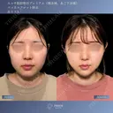 顔脂肪吸引・バッカルファット・糸リフト✨引き締めて整える 小顔トータルデザイン before画像 サムネイル用