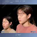 顔脂肪吸引・バッカルファット・糸リフト✨引き締めて整える 小顔トータルデザイン 30日後 サムネイル用