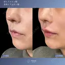一度で変わる、上品さと色気💋貴族、唇ヒアルロン酸 before画像 サムネイル用