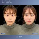 一度で変わる、上品さと色気💋貴族、唇ヒアルロン酸 0日後 サムネイル用