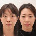 下眼瞼脱脂術（目の下のクマ・たるみ取り) before画像 サムネイル用