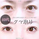 目の下のクマ取り/脂肪注入(目の下・ゴルゴライン) 90日後 サムネイル用