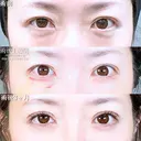目の下のクマ取り/脂肪注入(目の下・ゴルゴライン) before画像 サムネイル用