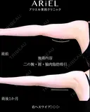 二の腕　肩　脇肉　脂肪吸引 before画像 サムネイル用