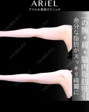 二の腕　肩　脇肉　脂肪吸引 30日後 サムネイル用