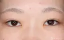 【10代女性・自然な二重に】二重全切開法（6ヶ月後） before画像 サムネイル用
