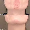 顎ボツリヌストキシン注射 before画像 サムネイル用
