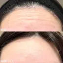 額ボツリヌストキシン注射 after画像 サムネイル用