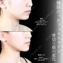 頬・頬骨上・顎下脂肪吸引 /バッカルファット/ジョールファット/糸リフト/エラ・顎ボトックス／顎ヒアルロン酸  before画像 サムネイル用