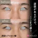 涙袋ヒアルロン酸 before画像 サムネイル用