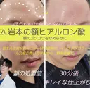 額ヒアルロン酸 0日後 サムネイル用