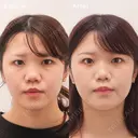 下眼瞼脱脂術（目の下のクマ・たるみ取り) before画像 サムネイル用