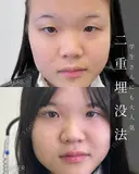 二重埋没法 before画像 サムネイル用