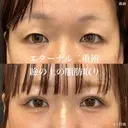 二重埋没（エターナル二重術）+瞼の上の脂肪取り before画像 サムネイル用