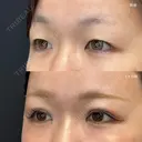 二重埋没（エターナル二重術）+瞼の上の脂肪取り after画像 サムネイル用