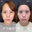 二重埋没（ルラループ二重術）+目の下のふくらみ取り（プラチナ）+脂肪注入（目の下～ゴルゴライン）ナノリッチ加工 before画像 サムネイル用