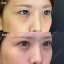 二重埋没（ルラループ二重術）+目の下のふくらみ取り（プラチナ）+脂肪注入（目の下～ゴルゴライン）ナノリッチ加工 after画像 サムネイル用