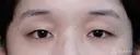 【20代女性・二重】マイクロメソッド3点（1ヶ月後） before画像 サムネイル用