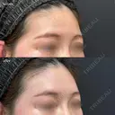 額こめかみヒアルロン酸（ボリフト４㏄+ボリューマ１㏄+ボルベラ１cc） after画像 サムネイル用