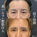 裏ハムラ+脂肪注入(目の下〜ゴルゴライン、額こめかみ、頬コケ) +眉下切開(ナチュラルロング) after画像 サムネイル用