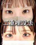 目元くっきり👀二重埋没 after画像 サムネイル用