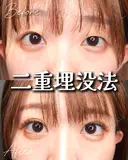 目元くっきり👀二重埋没 after画像 サムネイル用