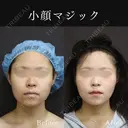 小顔マジック before画像 サムネイル用