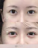 涙袋（ボルベラ） after画像 サムネイル用