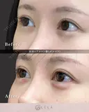 涙袋（ボルベラ） after画像 サムネイル用