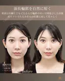 30代 | 口周り改善リフト before画像 サムネイル用