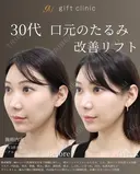 30代 | 口周り改善リフト 7日後 サムネイル用