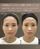 40代 | ほうれい線改善リフト before画像 サムネイル用