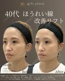 40代 | ほうれい線改善リフト after画像 サムネイル用