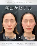 ハートシェイプ after画像 サムネイル用