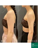 カリカリボディを目指す🌴コンプリート脂肪吸引【上腕全周～お背中一部】形成外科専門医がご対応 after画像 サムネイル用
