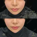 小顔Eライン（切らないあご形成） before画像 サムネイル用